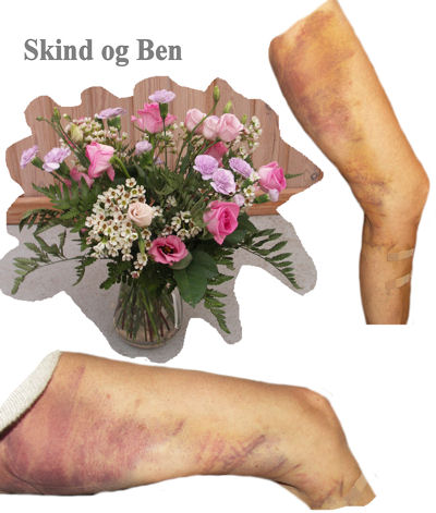 Skind og Ben